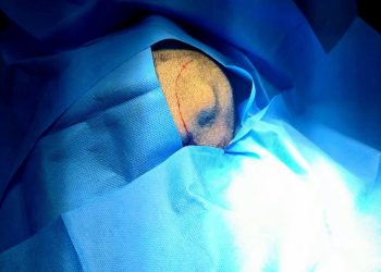 Atención médica especializada: Hospital de San Benito atiende a paciente con tumor cerebral
